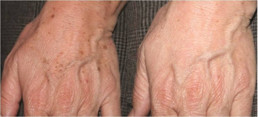 Rimozione macchie della pelle: con il laser Q-Switched puoi